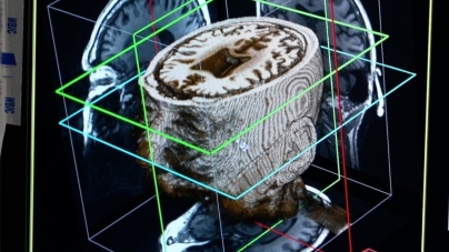 BRUSSELS: Artificial Intelligence may diagnose dementia in a day