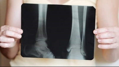 BONN: National Bone And Joint Day: Steer Clear Of Alcohol To Protect Your Bones After Recovery From Covid-19