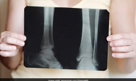 BONN: National Bone And Joint Day: Steer Clear Of Alcohol To Protect Your Bones After Recovery From Covid-19
