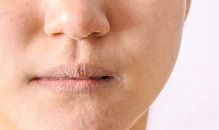 NEW DELHI: Skincare Tips: Try These Ayurvedic Remedies To Manage Dry Skin This Winter